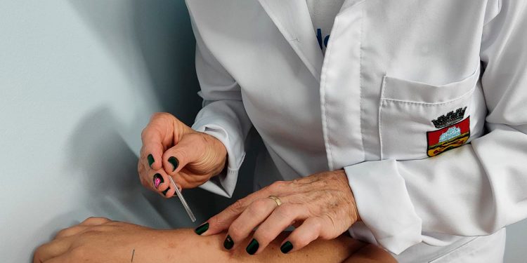 Secretaria de Saúde de Erechim disponibiliza acupuntura para pacientes com fibromialgia