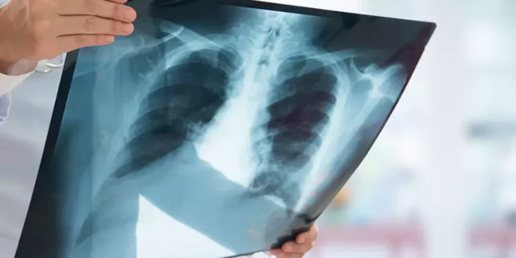 Incidência de tuberculose no RS supera em 40% a média nacional