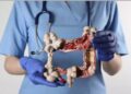 Doenças inflamatórias intestinais crescem mais de cinco vezes no Brasil em 13 anos