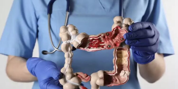 Doenças inflamatórias intestinais crescem mais de cinco vezes no Brasil em 13 anos